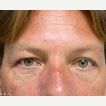 35-44 year old man treated with Eyelid Surgery after 3093429