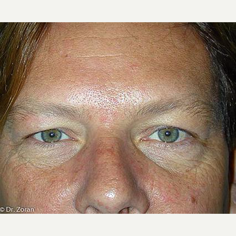 35-44 year old man treated with Eyelid Surgery before 3093429
