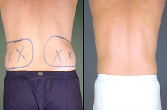 Flank Liposuction Under Local Anesthesia before 996405