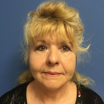 65-74 year old woman treated with Facelift after 3688690