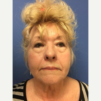 65-74 year old woman treated with Facelift before 3688690