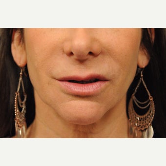 55-64 year old woman treated with Lip Lift before 2568834