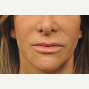 55-64 year old woman treated with Lip Lift after 2568834