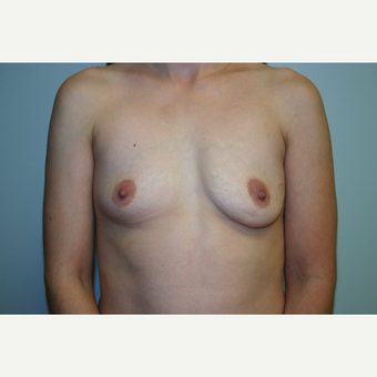 3 Years Post-op Breast Augmentation before 3054284