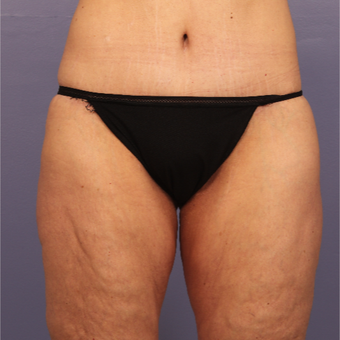 45-54 year old woman treated with Body Lift after 3666041