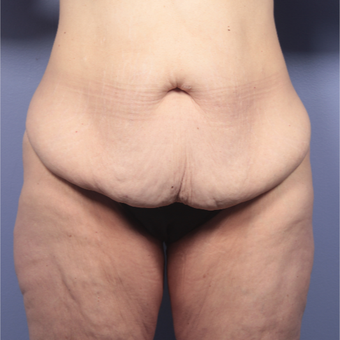 45-54 year old woman treated with Body Lift before 3666041