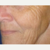 65-74 year old woman treated with Fractionated CO2 Laser Skin Resurfacing before 2848144