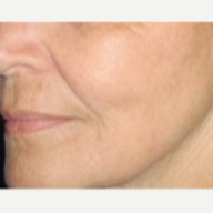 65-74 year old woman treated with Fractionated CO2 Laser Skin Resurfacing after 2848144