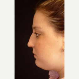 Rhinoplasty before 3535048