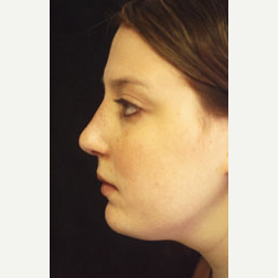Rhinoplasty after 3535048