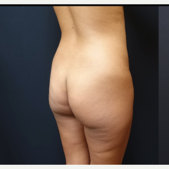 25-34 year old woman treated with Fat Transfer before 3731844