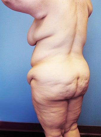 High-Definition™ Total Body Lift before 177428