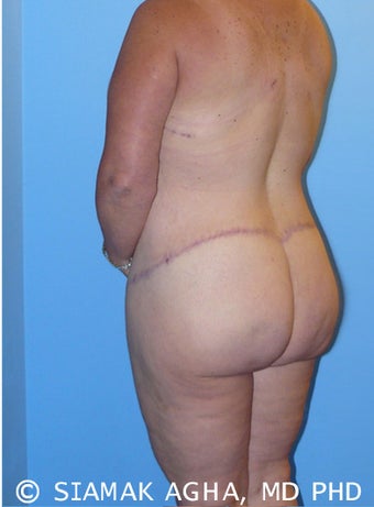 High-Definition™ Total Body Lift after 177428
