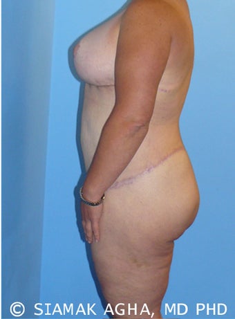 High-Definition™ Total Body Lift 177428