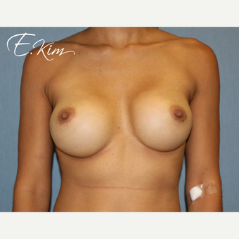 25-34 year old woman treated with Breast Implant Removal before 3102551