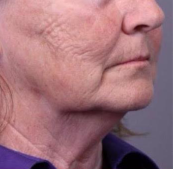 65-74 year old woman treated with Facelift before 3769312