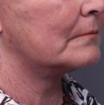 65-74 year old woman treated with Facelift after 3769312