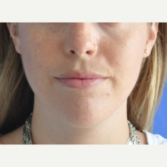 25-34 year old woman treated with Lip Augmentation after 3219567