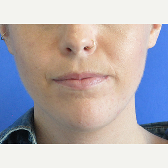 25-34 year old woman treated with Lip Augmentation before 3219567