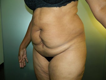 43 Year Old Female Treated with TT 1517103