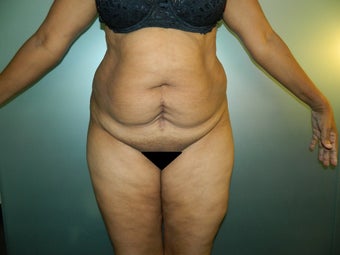 43 Year Old Female Treated with TT before 1517103
