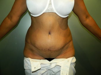 43 Year Old Female Treated with TT after 1517103