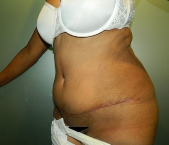 43 Year Old Female Treated with TT 1517103