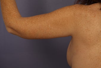 Arm Lift after 1119980