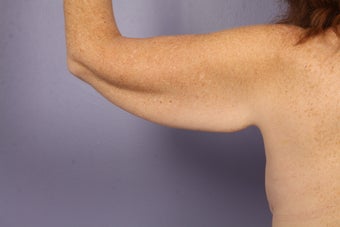 Arm Lift before 1119980