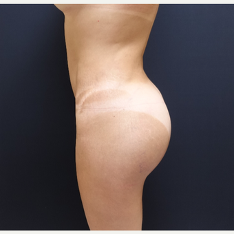 35-44 year old woman treated with Butt Augmentation after 3234492