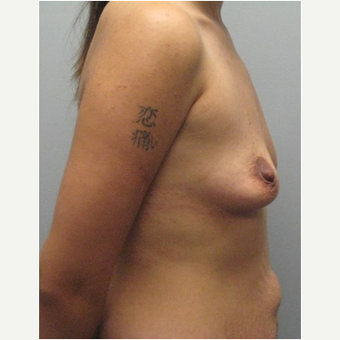 25 year old woman treated with Mommy Makeover before 3679977
