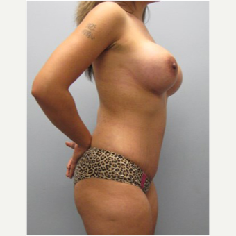 25 year old woman treated with Mommy Makeover after 3679977