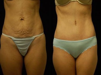 Abdominoplasty before 503890
