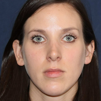 Bellafill or Permanent Filler for Nose Job Correction and for Lip Augmentation. before 3777352
