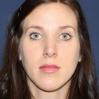 Bellafill or Permanent Filler for Nose Job Correction and for Lip Augmentation. after 3777352