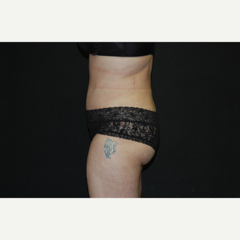 35-44 year old woman treated with Tummy Tuck after 3076458