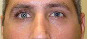 Socket surgery (prosthetic eye) after 332443