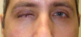 Socket surgery (prosthetic eye) before 332443