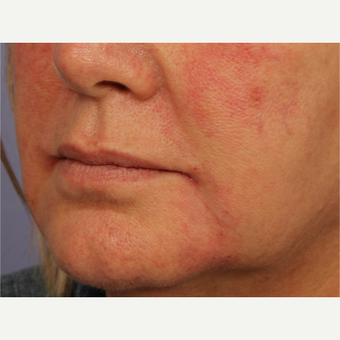 55-64 year old woman treated with Perlane after 3709800