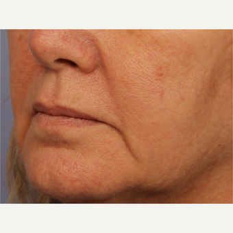 55-64 year old woman treated with Perlane before 3709800