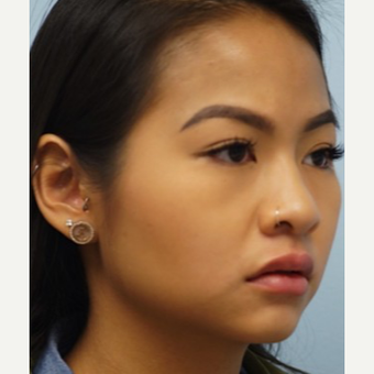 25-34 year old woman treated with Lip Augmentation after 3716305