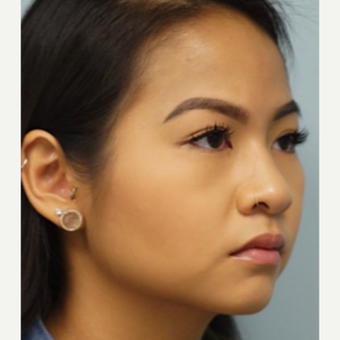 25-34 year old woman treated with Lip Augmentation before 3716305
