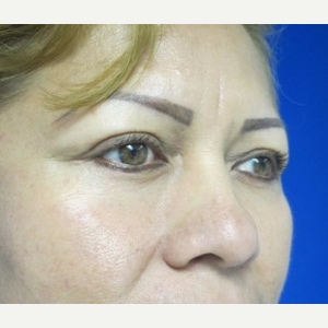 Eyelid Surgery after 3164329