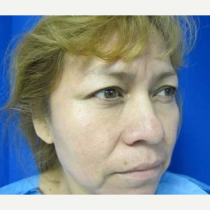 Eyelid Surgery before 3164329