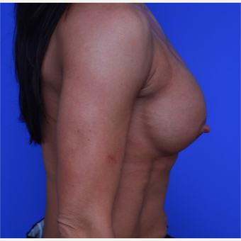 33- year old woman treated with Breast Augmentation before 3652758
