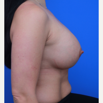 33- year old woman treated with Breast Augmentation after 3652758