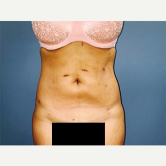 25-34 year old woman treated with Laser Liposuction after 3763970