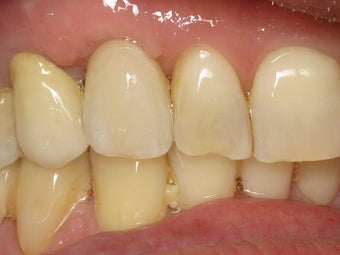 Implant Crown with Zirconia Abutment Before & After Photo after 996259