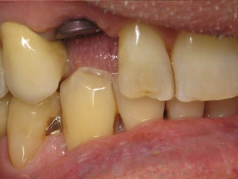 Implant Crown with Zirconia Abutment Before & After Photo before 996259
