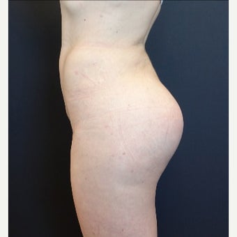 25-34 year old woman treated with Butt Implants and Fat Transfer after 2342502